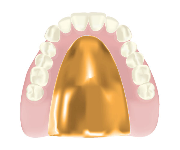 ゴールド床入れ歯